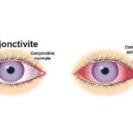 Conjonctivite-MyAfricaInfos