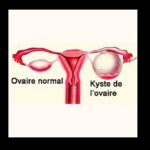 kyste-ovarien-MyAfricaInfos