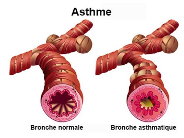 Asthma_MyAfricaInfos